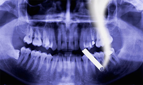зубы курильщика